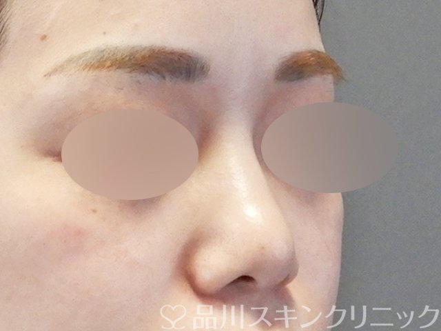 症例NO.67385のBEFORE写真
