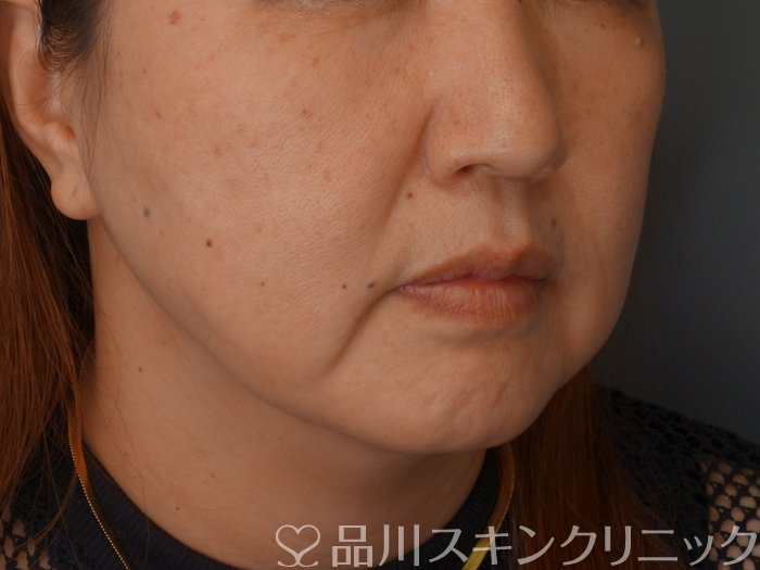 症例NO.75278のBEFORE写真