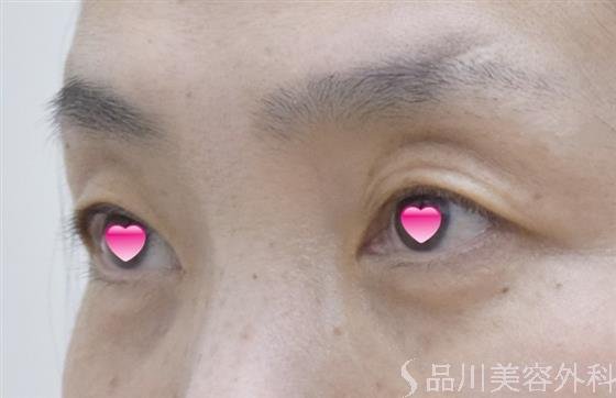 症例NO.54461のAFTER写真
