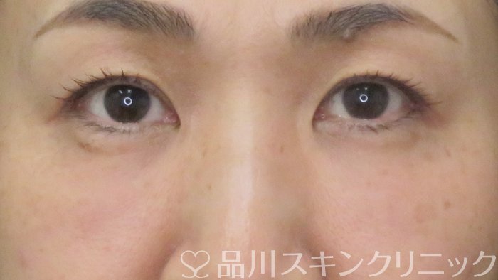 症例NO.72404のAFTER写真