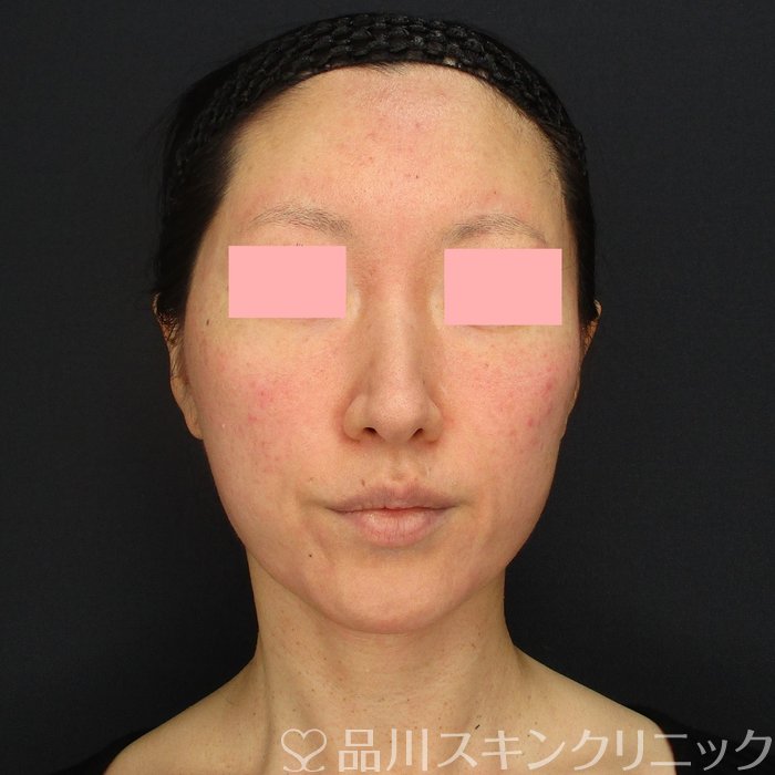 症例NO.70018のBEFORE写真