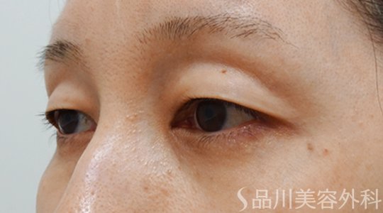 症例NO.70162のBEFORE写真