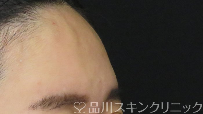 症例NO.72293のAFTER写真