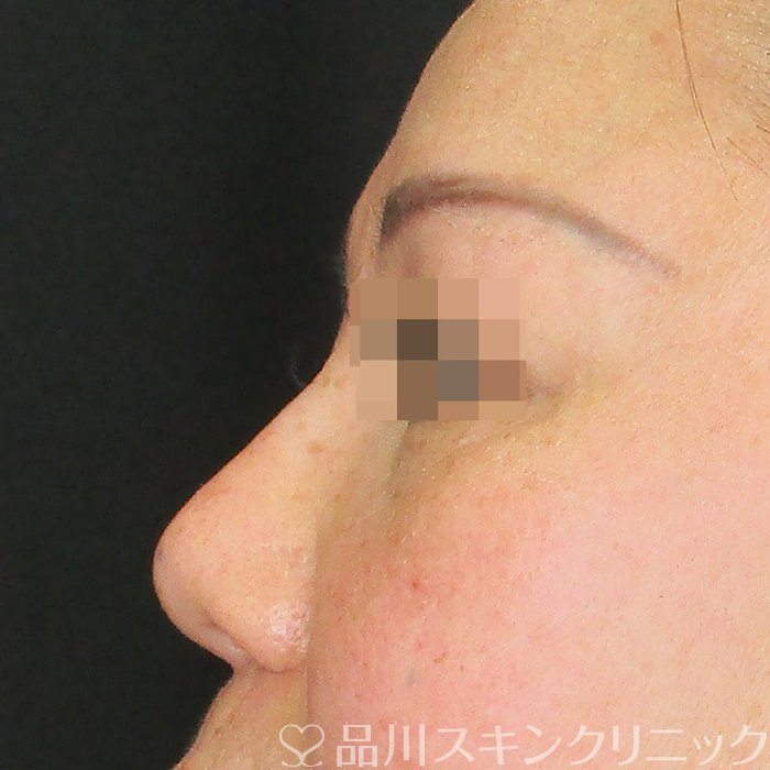 症例NO.73184のAFTER写真