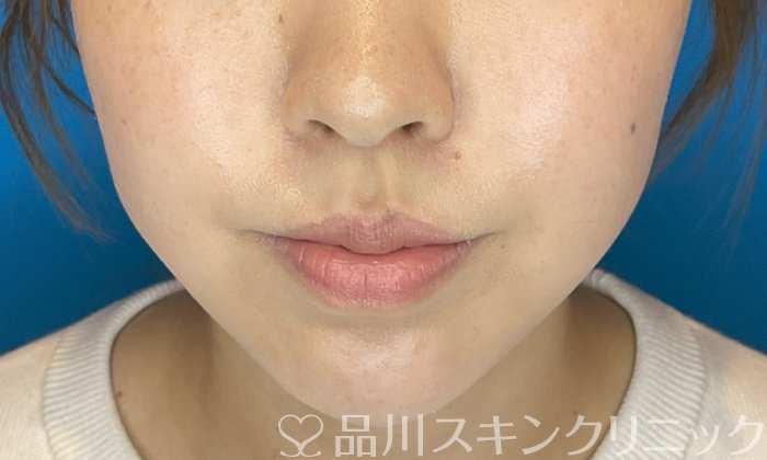 症例NO.74828のAFTER写真