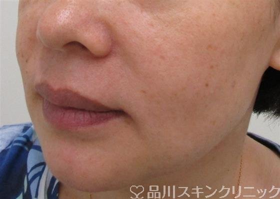 症例NO.37445のBEFORE写真