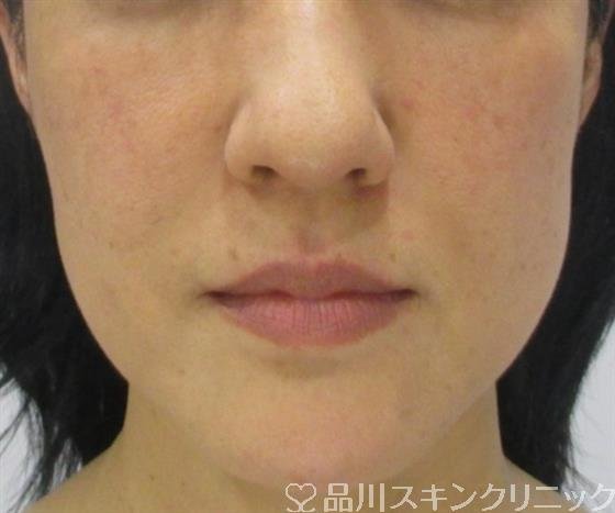 症例NO.32518のAFTER写真