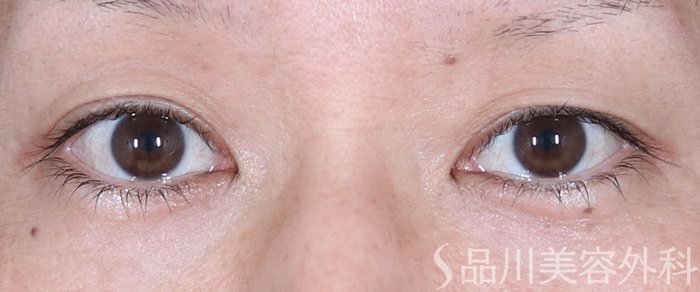 症例NO.72401のBEFORE写真