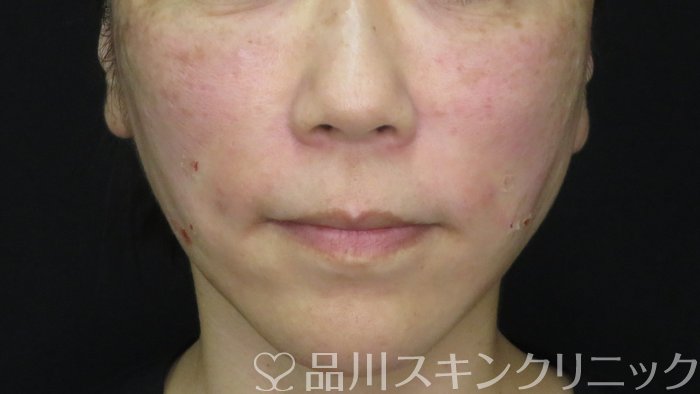 症例NO.71922のAFTER写真