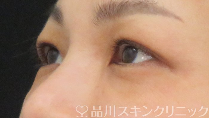 症例NO.72909のAFTER写真