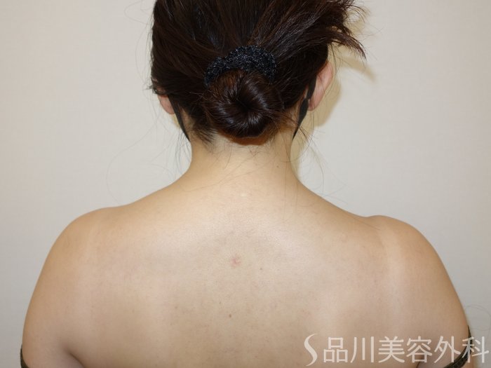 症例NO.73271のAFTER写真