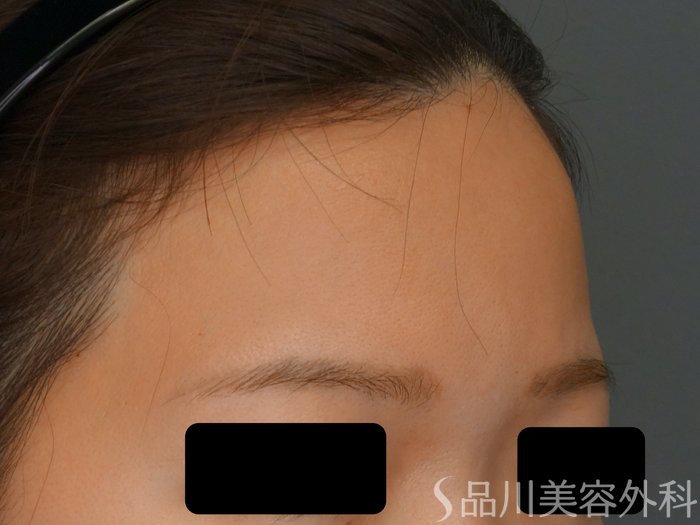 症例NO.69293のBEFORE写真