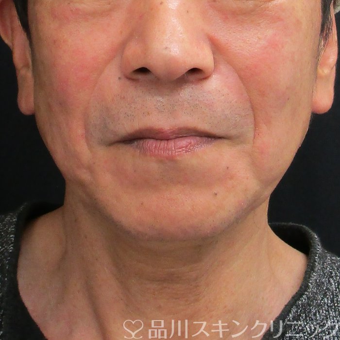 症例NO.74154のAFTER写真