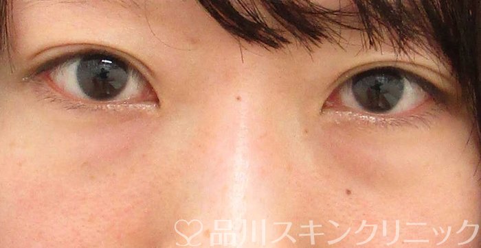 症例NO.64025のBEFORE写真