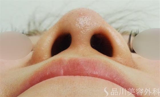 症例NO.23644のAFTER写真