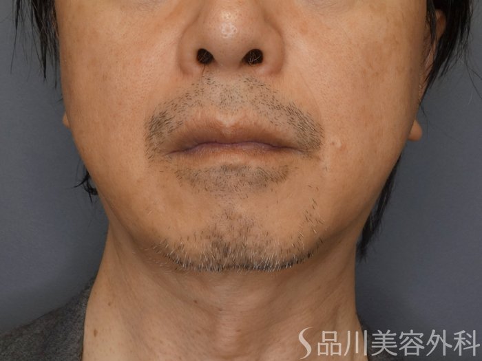 症例NO.72036のBEFORE写真