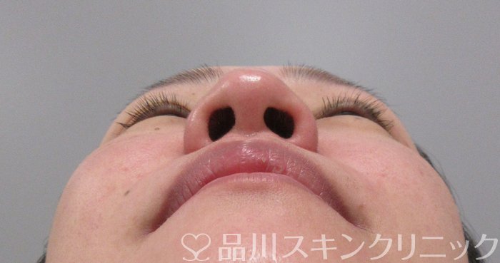 症例NO.74117のBEFORE写真