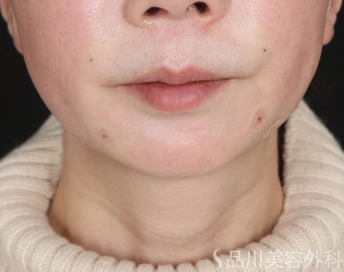 症例NO.72464のAFTER写真