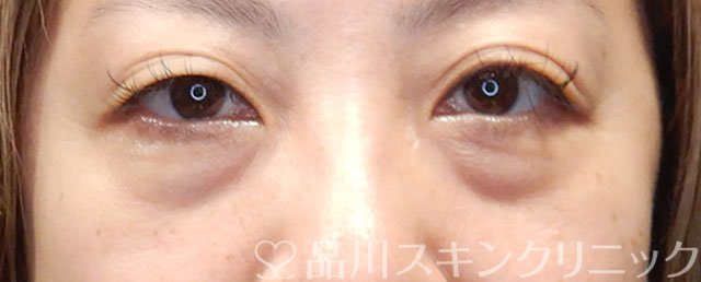 症例NO.72694のBEFORE写真