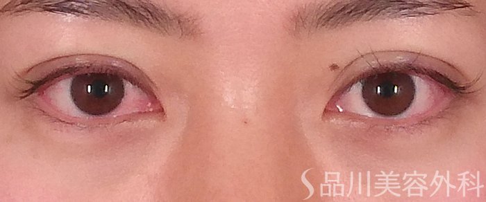 症例NO.70256のAFTER写真