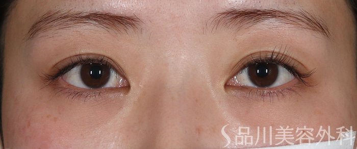 症例NO.72587のBEFORE写真