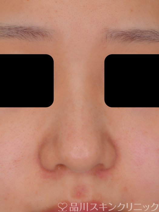 症例NO.73330のBEFORE写真