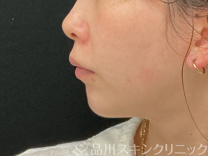 症例NO.74528のBEFORE写真