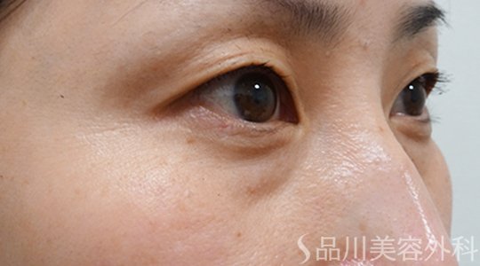 症例NO.72627のBEFORE写真