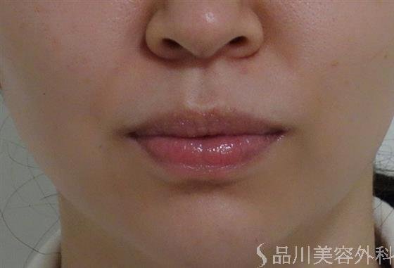 症例NO.53227のBEFORE写真