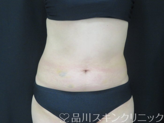症例NO.68018のAFTER写真
