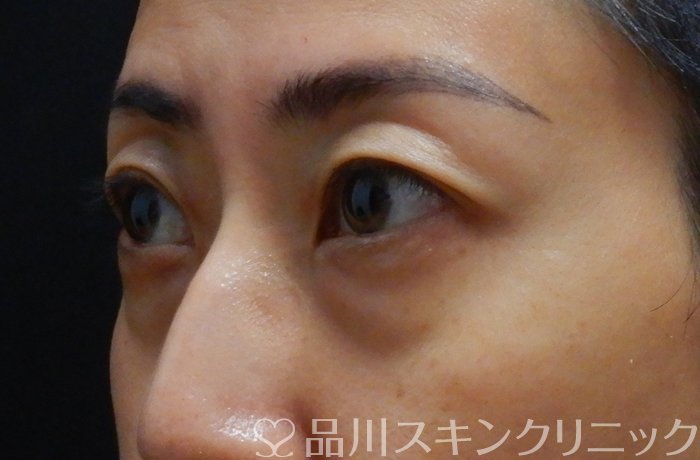 症例NO.67501のBEFORE写真