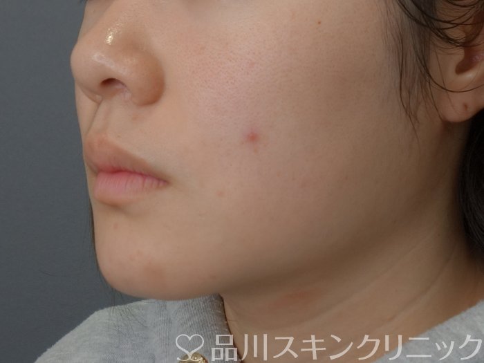 症例NO.73671のBEFORE写真