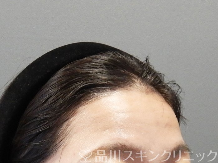 症例NO.75258のBEFORE写真
