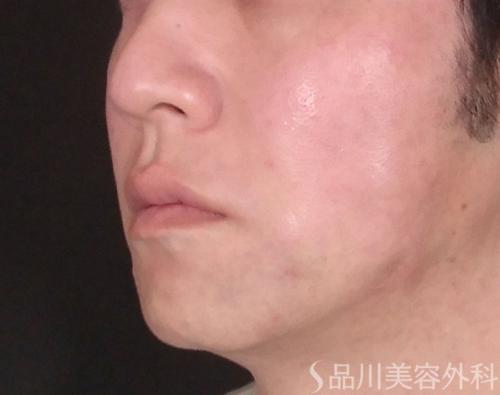 症例NO.72540のAFTER写真