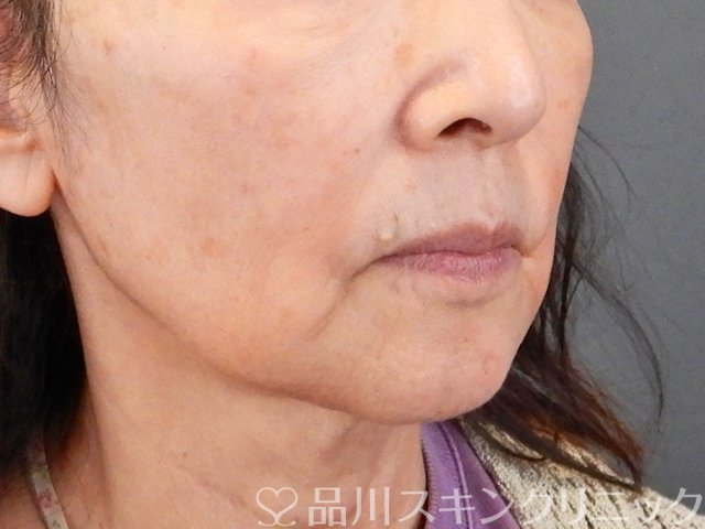 症例NO.75299のBEFORE写真