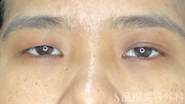 症例NO.72198のBEFORE写真