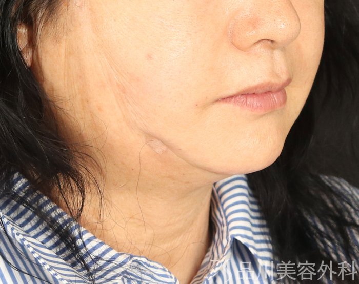 症例NO.72465のAFTER写真