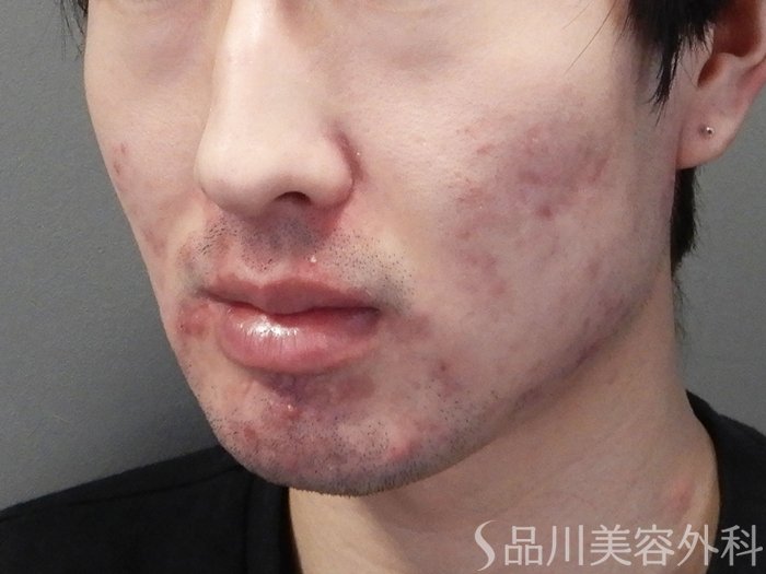 症例NO.72298のBEFORE写真