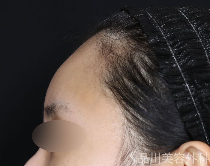 症例NO.70836のBEFORE写真
