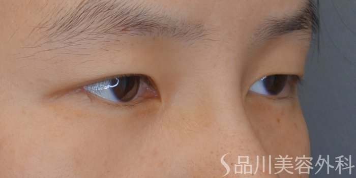症例NO.74096のBEFORE写真