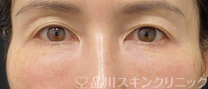 症例NO.74861のAFTER写真