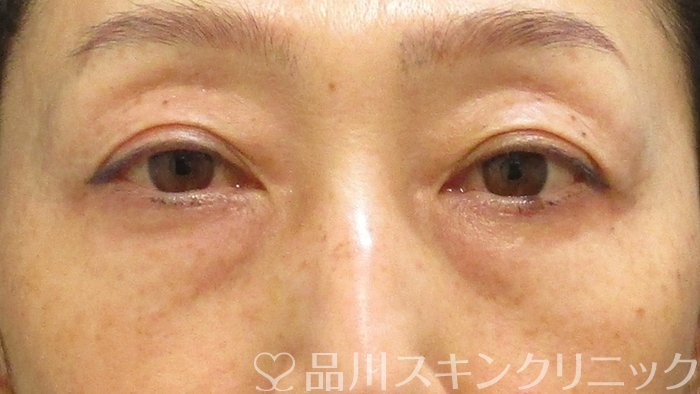 症例NO.74755のBEFORE写真