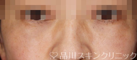 症例NO.63903のAFTER写真