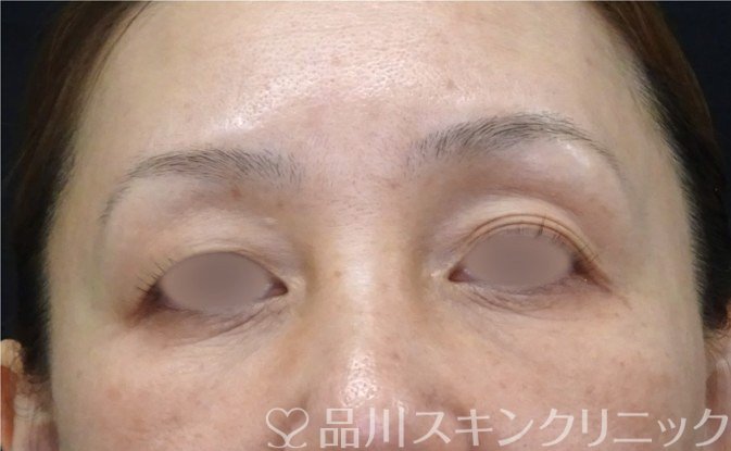症例NO.71150のAFTER写真