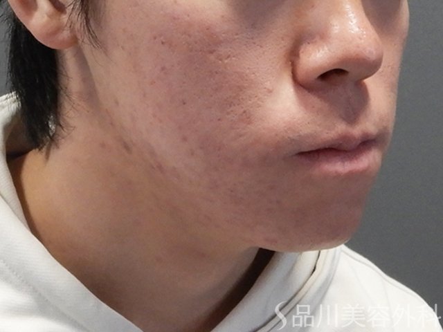 症例NO.69826のAFTER写真