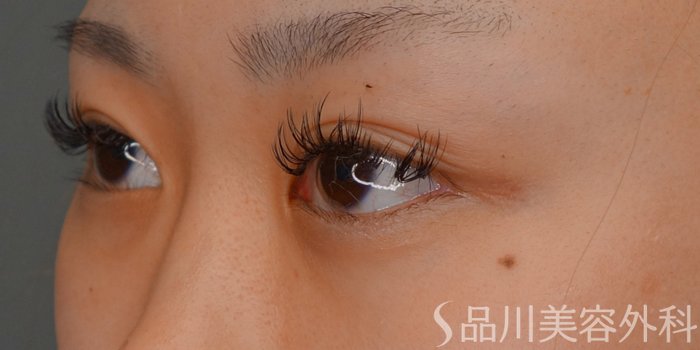 症例NO.73515のBEFORE写真