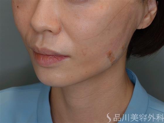 症例NO.51087のAFTER写真