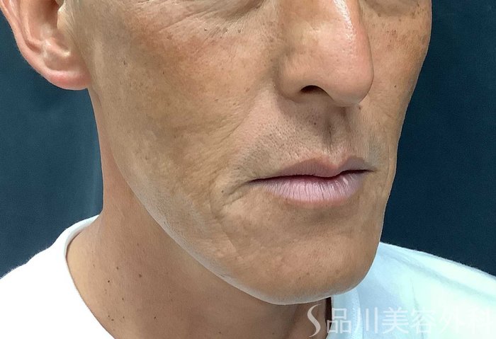 症例NO.71042のAFTER写真