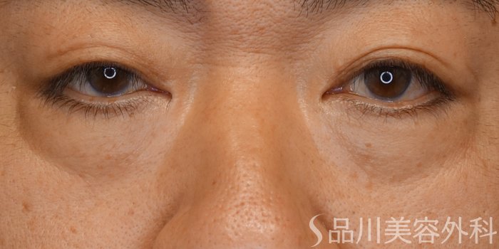 症例NO.70622のBEFORE写真