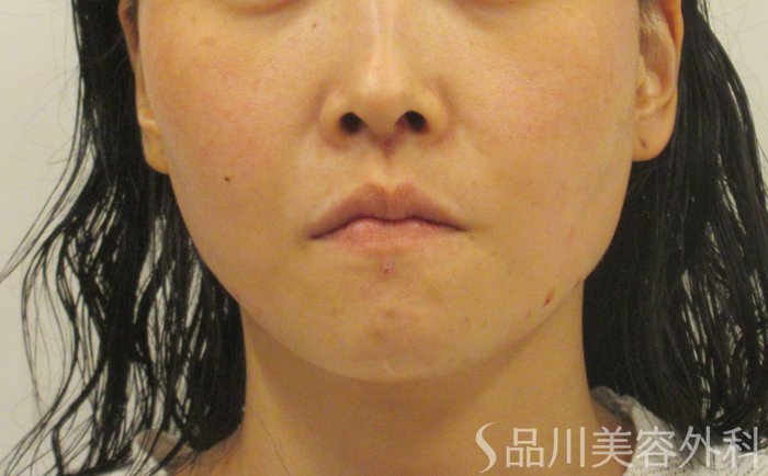 症例NO.71876のAFTER写真